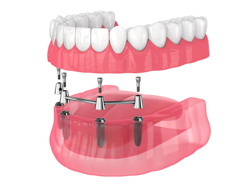 All-on-4 dental implants available at Romeoville Smiles in Romeoville, IL