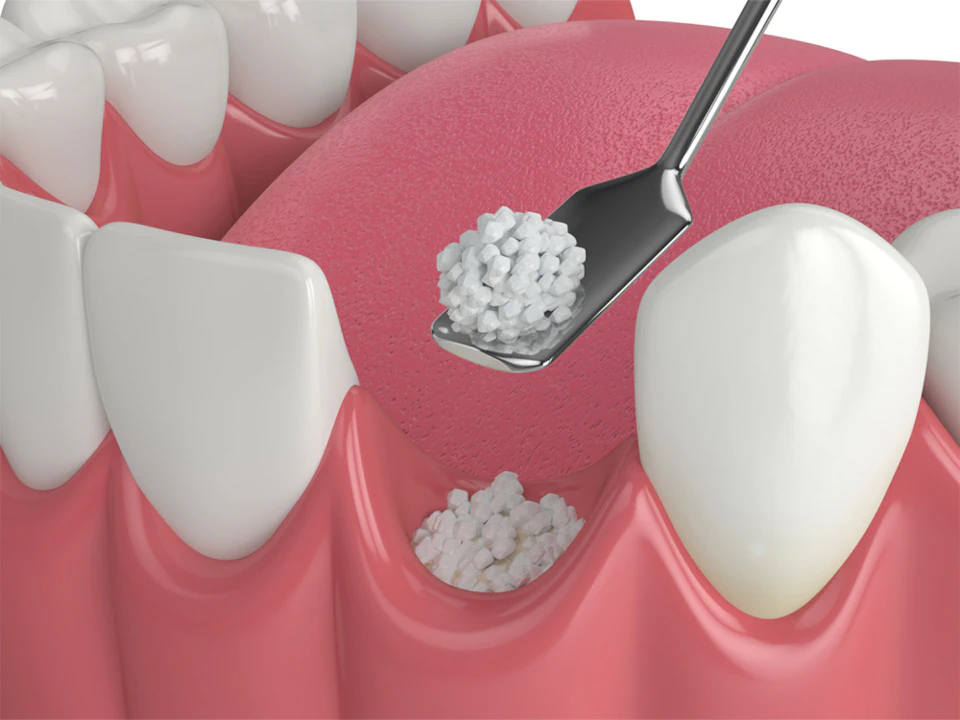 Dental Bone Grafting available at Romeoville Smiles in Romeoville, IL
