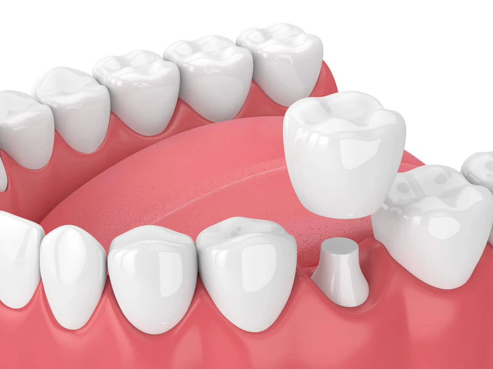Dental crowns and bridges available at Romeoville Smiles in Romeoville, IL