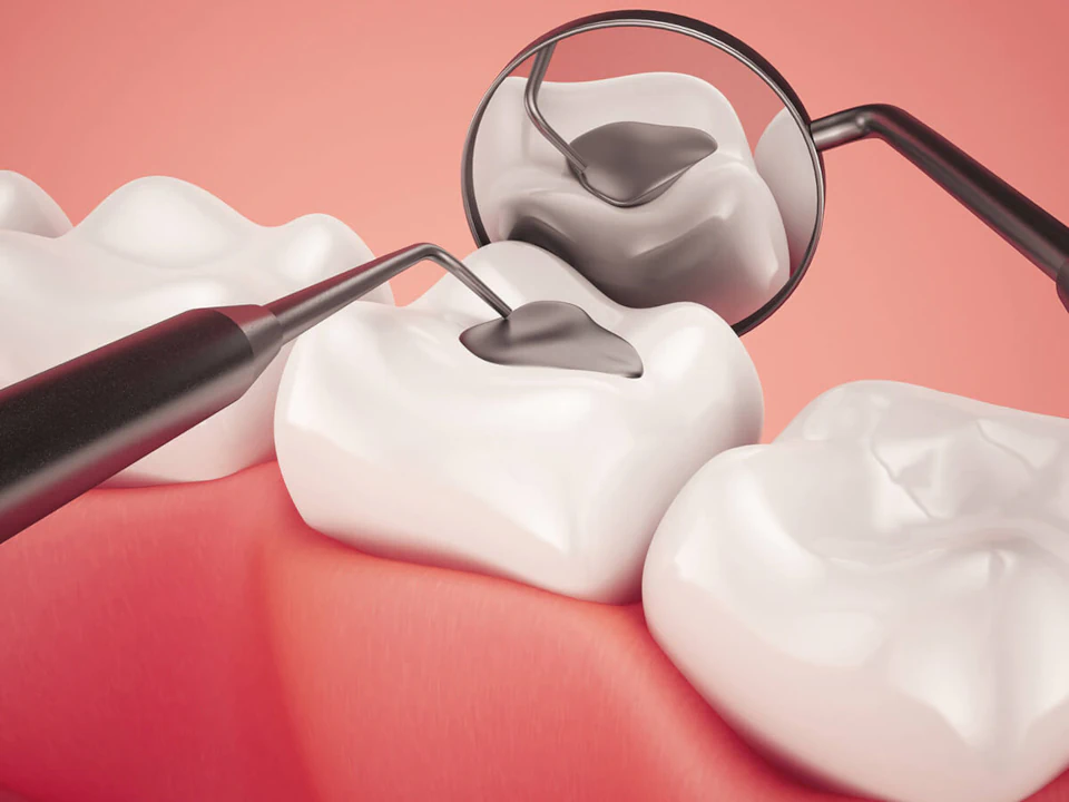 Tooth fillings and tooth sealants available at Romeoville Smiles in Romeoville, IL