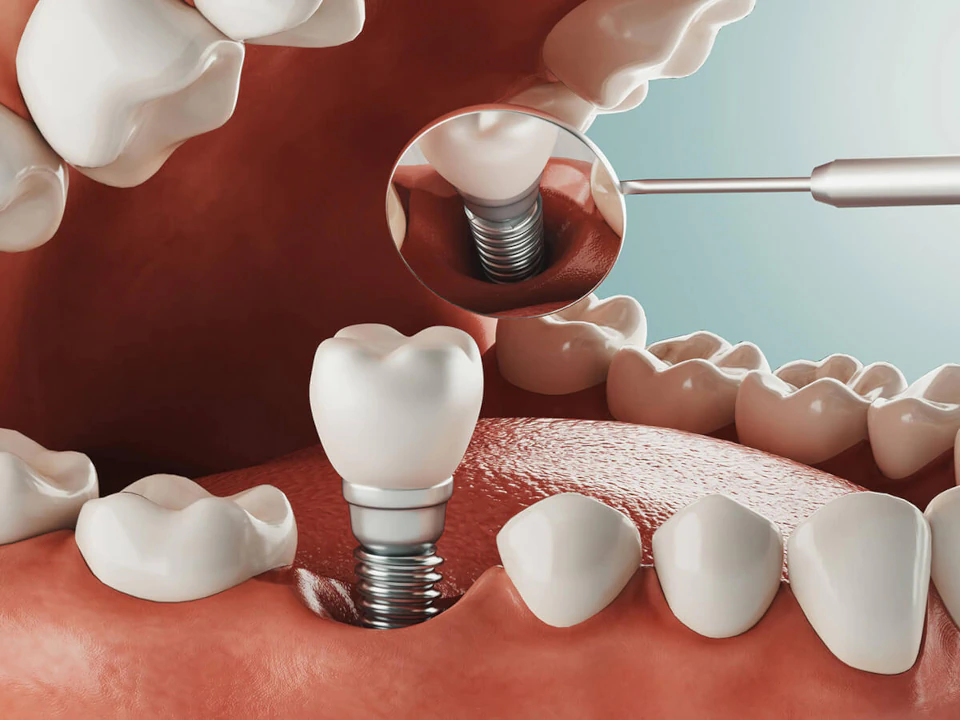Dental Implant services at Romeoville Smiles in Romeoville, IL