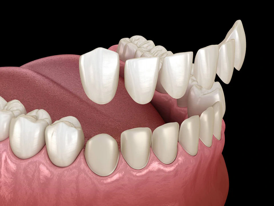Dental Veneers available at Romeoville Smiles in Romeoville, IL