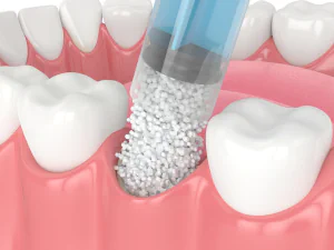 About dental bone grafting at Romeoville Dental Center in Romeoville, IL